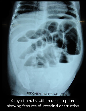 X Ray of a Baby with Intussusception showing features of Intestinal Obstruction