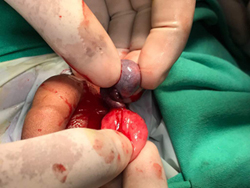 Testicular Torsion